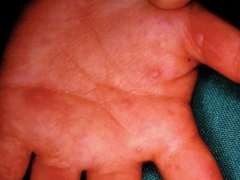 Figure 3: Hand, foot, and mouth disease of the han